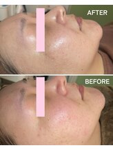 ギルドハナレ(GUILD HANARE)/"プラズマシャワー"