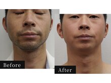 ハル(HAL)の雰囲気(ヒゲ脱毛込み★全身脱毛(VIO込)初回限定14,500円《地域最安値》)