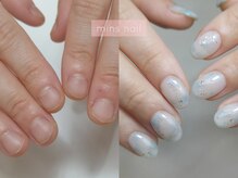 ミンスネイル(Mins Nail)/深爪矯正before&after