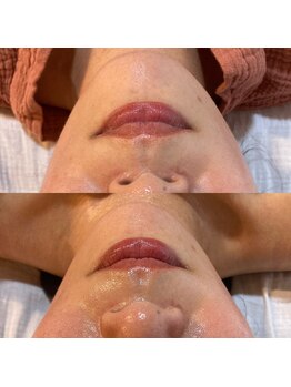 ララルアナ(Lara luana)/バザルト小顔ケア