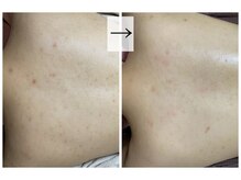 おうちサロン ミキ/背中ニキビ、ポツポツ背中