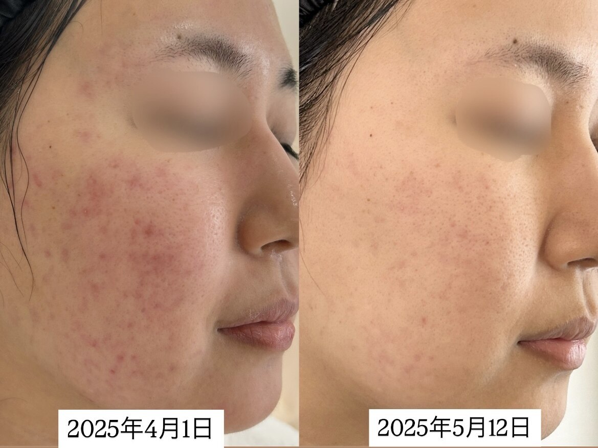 肌質改善エステサロン♡ ピヌ(Pinu)｜ホットペッパービューティー