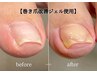 【巻き爪改善ジェル】３本以上　¥3,500