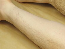 ピンセットでの後処理なし!WAXのみでツルツルに！！