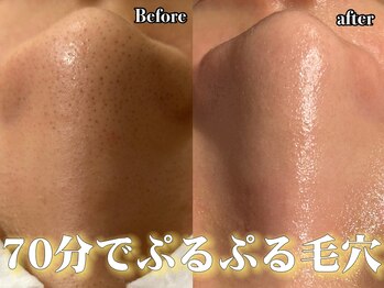 ウル 下北沢(Ulu)/韓国式3D毛穴洗浄