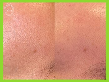 ヴィオール 名古屋栄店(VIOR)/たるみ毛穴にアプローチ
