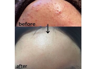 サロンドシュシュ 心斎橋本店(salon de chouchou)/小さなニキビを集中ケア