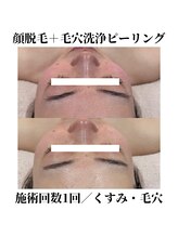 サラ/顔脱毛＋毛穴洗浄ピーリング
