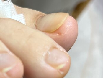 エルユーネイルズ(LUnails)/巻き爪カット
