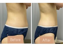 FJ/お腹周りの頑固なセル脂肪ケア