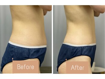 FJ/お腹周りの頑固なセル脂肪ケア