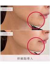 エミル(Emillu)/＊facial_ビフォーアフター