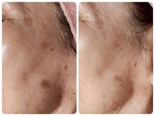 【肌悩み改善】お肌の土台から整えて憧れの素肌へ♪