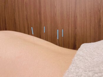 高田馬場名倉堂鍼灸接骨院/鍼