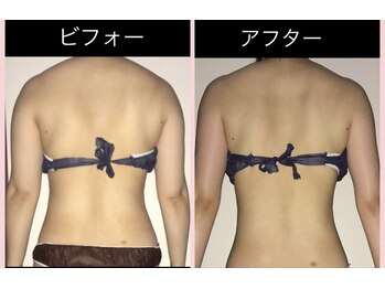 トータルエステティック レイ(Lay)/背中のお肉、二の腕もすっきり♪