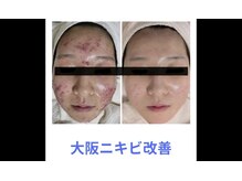 レゾン 京橋店の雰囲気（《完全個室で施術》当店一番人気のニキビケアコースで透明感UP☆）