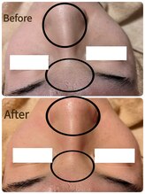 ラーナ(Lana)/メンズ毛穴洗浄BIFORE→AFTER☆