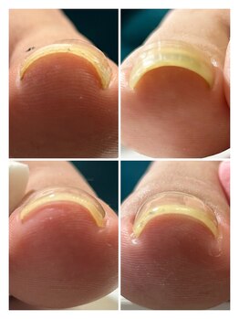 ハッチネイル(HACCI nail)/お客様BEFORE/AFTER