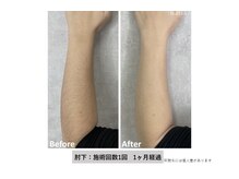 スプレール 水戸店/メンズ脱毛