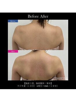 リアン/【痩身/毛穴/たるみケア】