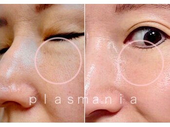 アールスタイルビューティ(R STYLE BEAUTY)/プラズマニア[フェイシャル]毛穴
