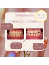 プラスビー 2号店(+b)/ホワイトニングビフォーアフター