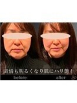 チョコバリ 錦糸町店(chocobari)/小顔×リフトアップ(美容鍼)40代