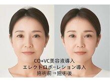 憩いサロン ユリ(yuri)/エレクトロポーレション導入