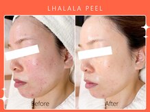 ハノハノ 八代店(HANO HANO)/韓国肌管理ララピール☆