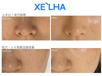 カピリナスパ(Ka.Pilina Spa)/セラピール before⇒after症例