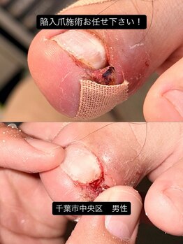 巻き爪じゅん 千葉駅前店/深刻な陥入爪の痛みを改善へ