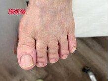レフス 北参道店(REFUSS)/トータルフットケア（施術後）