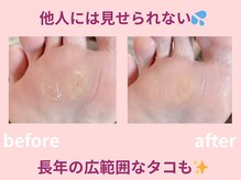 スロース鍼灸整体院(SLOTH鍼灸整体院)/広範囲にできたタコもキレイに