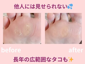 スロース鍼灸整体院(SLOTH鍼灸整体院)/広範囲にできたタコもキレイに