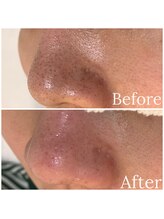 ウエカ(ueka)/毛穴が広がりすぎるその前に改善