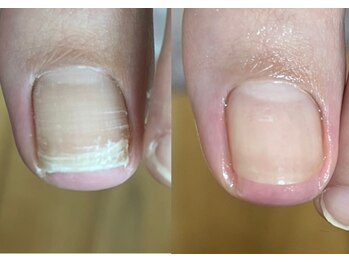 エルユーネイルズ(LUnails)/巻き爪カット