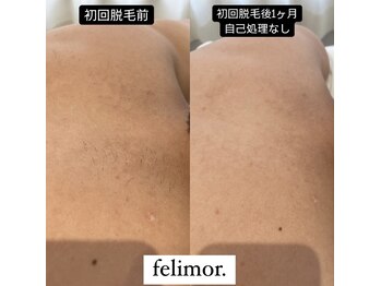 フェリモール(Felimor.)/メンズ光脱毛