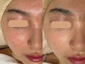 ブルーエム 大森(Blue-M)/お疲れ肌をリセット