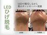 【価格ダウン】メンズ髭脱毛　産毛にも効果（眉毛・鼻毛）も脱毛できます。　
