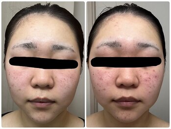 ビーシェイプ 君津(B-Shape)/症例【ハーブピーリング】