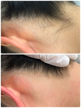 ミリプラス(MiLi +)/うなじ/襟足/産毛