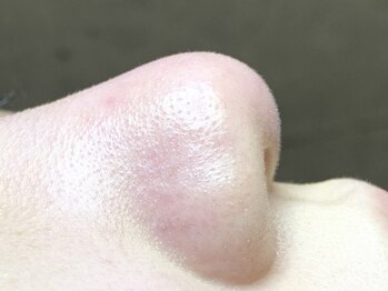 アーフ(ARF)の写真/《驚きの効果を実感！》リピーター多数の毛穴肌質改善がおすすめ◎話題の医師監修Exo Liftも◇