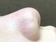 アーフ(ARF)の写真/《驚きの効果を実感！》リピーター多数の毛穴肌質改善がおすすめ◎話題の医師監修Exo Liftも◇