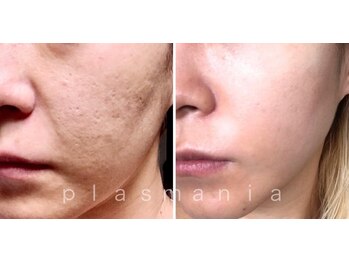 アールスタイルビューティ(R STYLE BEAUTY)/プラズマニア[フェイシャル]