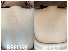 ハーブピーリング 心斎橋/背中ニキビ改善