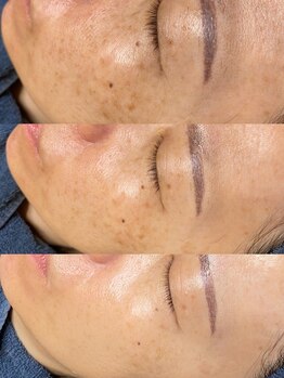 ソリッジ肌管理室/シミケア