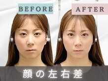 エルシンメトリー矯正院(ailesシンメトリー矯正院)/before＆after　ailes式小顔矯正