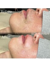 サロンロン 横浜関内(SALON RON)/髭脱毛/美容電気脱毛