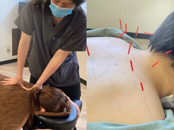 フォーゼ鍼灸整骨院の写真/首、肩こりや肩甲骨周りの頑固なコリの塊には鍼灸の刺激が効果大◎溶けるように柔らかくなる感覚を体験