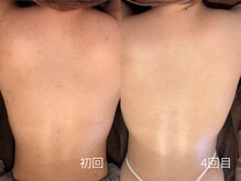 エミルカ 日の出平井店(EMILUCA)/ますます背中美人へ♪